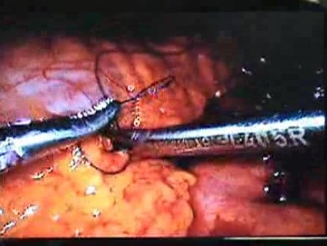 Jejunal Gastrointestinal Stromal tumor (GIST) (63 of 86)