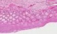 Pseudomembranous Colitis