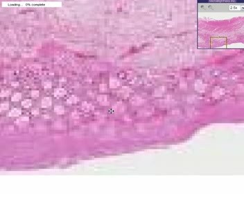 Pseudomembranous Colitis