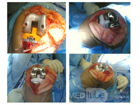 Total Knee Arthroplasty