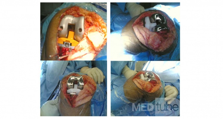 Total Knee Arthroplasty