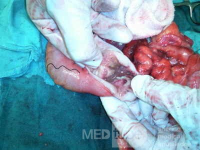 Non-Hodgkin's Lymphoma of the Colon (7 of 16)