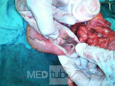 Non-Hodgkin's Lymphoma of the Colon (7 of 16)