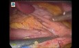 Laparoscopic Sleeve Gastrectomy in 10 steps - Part 1