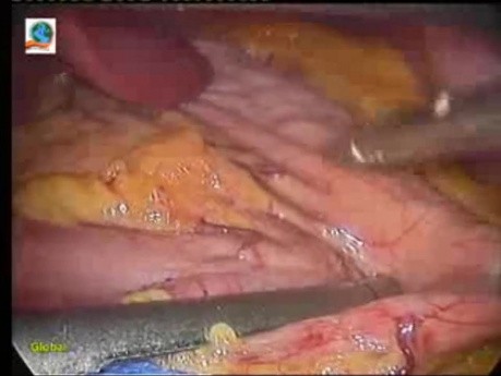 Laparoscopic Sleeve Gastrectomy in 10 steps - Part 1
