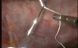 Laparoscopic ventral hernia repair