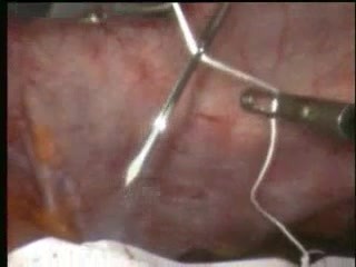 Laparoscopic ventral hernia repair