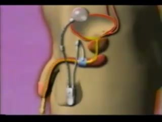 Artificial Urinary Sphincter - Animation