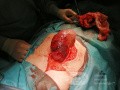 Obstructive Ileus - Right Colon Flexure Cancer