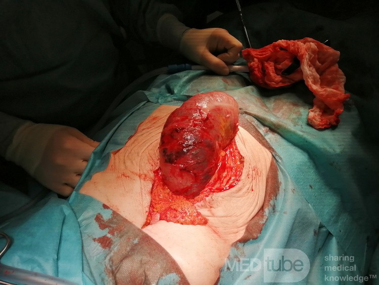 Obstructive Ileus - Right Colon Flexure Cancer