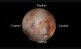 Unilateral Endoscopic Cervical Laminoplasty by 30 Degree Endoscopy