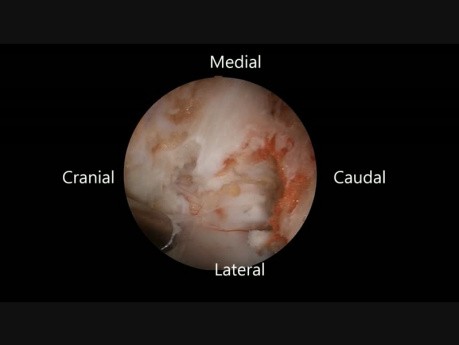 Unilateral Endoscopic Cervical Laminoplasty by 30 Degree Endoscopy