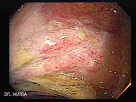 Severe case of Ischemic Colitis (5 of 19)
