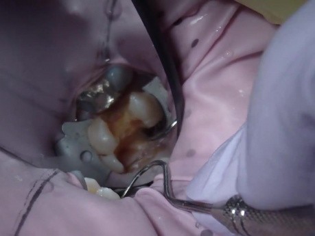 Decision Making: High Caries Risk And Endodontic Therapy Or Indirect Pulp Cap