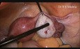 Laparoscopic Tubal Patency Test and Ovarian Drilling