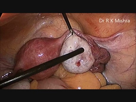 Laparoscopic Tubal Patency Test and Ovarian Drilling