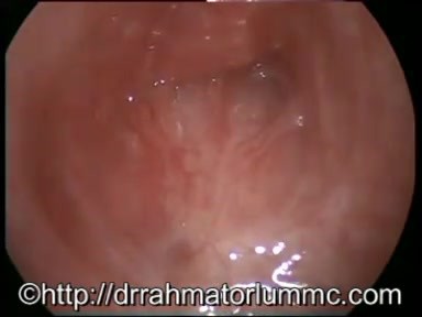 Complete Upper Tracheal Obstuction - Dense Scar Tissue