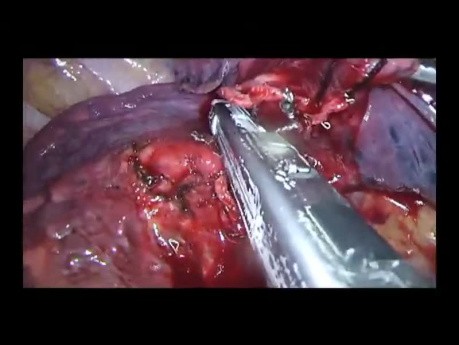 Uniportal VATS En Bloc Middle Lobectomy and Segment S2
