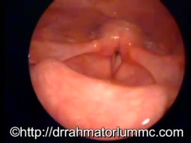 Cricotracheal Stenosis
