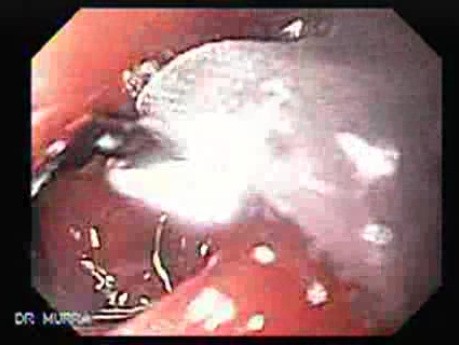 Intragastric Balloon - The Treatment Of Obesity (2 of 13)