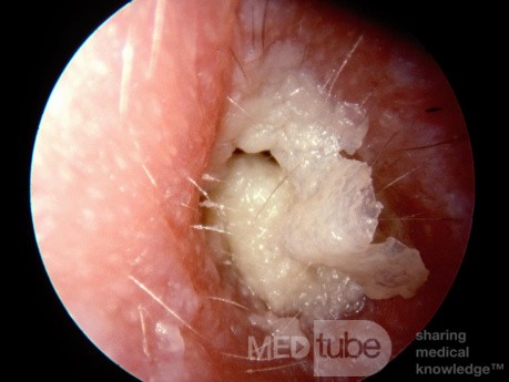 Chronic Otitis Externa Showing Large White Keratin Sheets