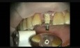 Implant Microsurgery: Immediate Implant and Provisional Upper Central Incisor