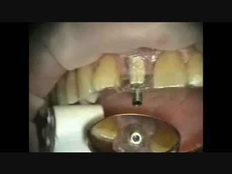 Implant Microsurgery: Immediate Implant and Provisional Upper Central Incisor