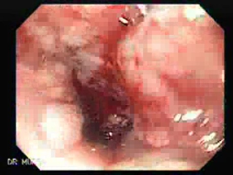 Gastric Adenocarcinoma That Has Been Manifested With Hiccups (1 of 5)