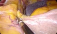 Laparoscopic Mini Gastric Bypass