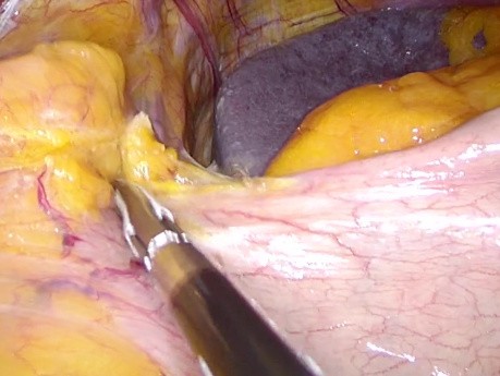 Laparoscopic Mini Gastric Bypass