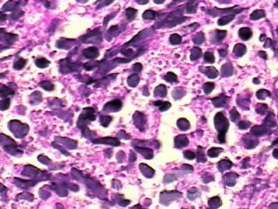 Histoplasmosis of the Colon and Condyloma Accuminata (9 of 11)