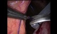 Laparoscopic gastrostomy