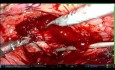 Transvesical Prostatectomy on Patient with 283g Prostate