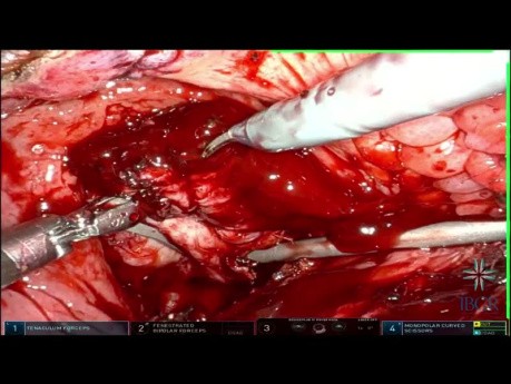 Transvesical Prostatectomy on Patient with 283g Prostate