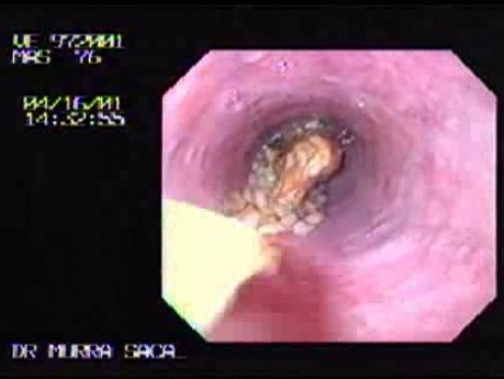 Polypectomy Snare in Non-typical Usage - 76 Years-Old Man