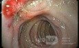 Duodenal Bulb Ulcers