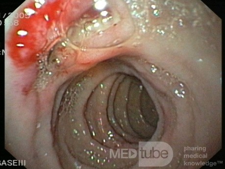 Duodenal Bulb Ulcers