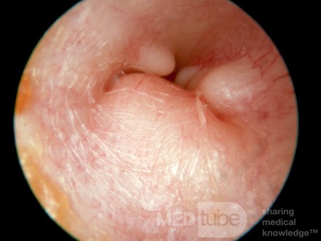 Massive Exostoses