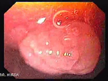 Esophageal Squamous Cell Papilloma - Magnified Esophagoscopy - 1/2