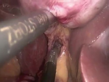 SILS cholecystectomy with needle retractor
