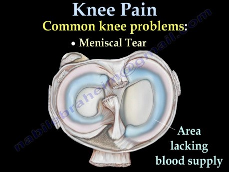 Common Causes of Knee Pain
