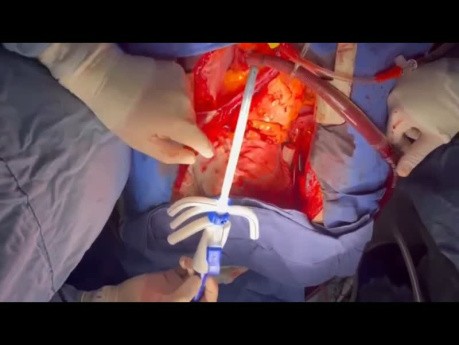 Patient with Extensive Ascending and Descending Thoracic Aorta Dissection