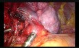 Subxiphoid Uniportal Complex Middle Lobectomy