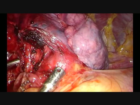 Subxiphoid Uniportal Complex Middle Lobectomy