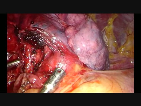Subxiphoid Uniportal Complex Middle Lobectomy