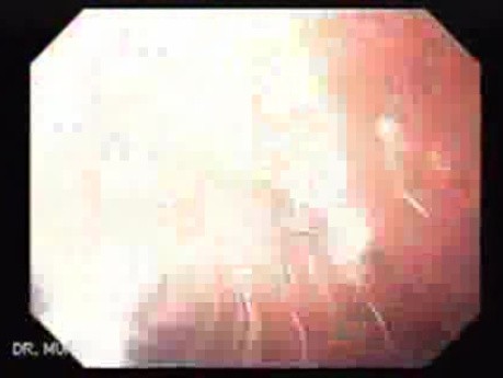 Colonic Interposition for Esophageal Substitution (7 of 11)