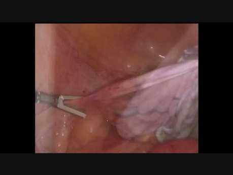 Manegement of a Giant Adnexal Cyst