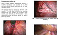 Safety and Feasibility of Using a 5 mm High-Definition 30-Degree Angled Scope in Laparoscopic Cholecystectomy