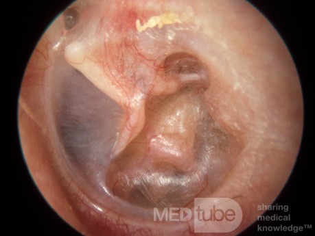 Atelectasis of the Tympanic Membrane