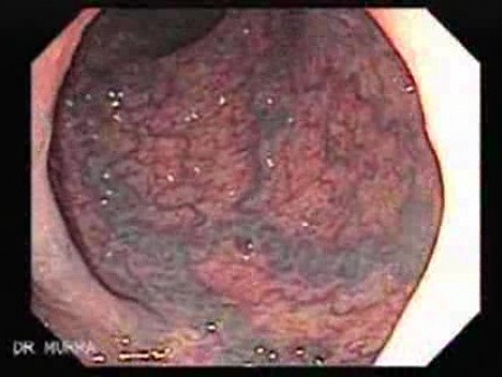Diffuse Colonic Varices (2 of 4)